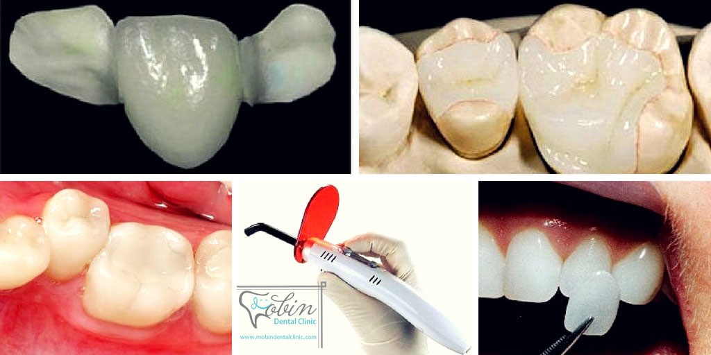 کامپوزیت های دندان برای سفید کردن و رفع نواقص دندانی استفاده می شوند